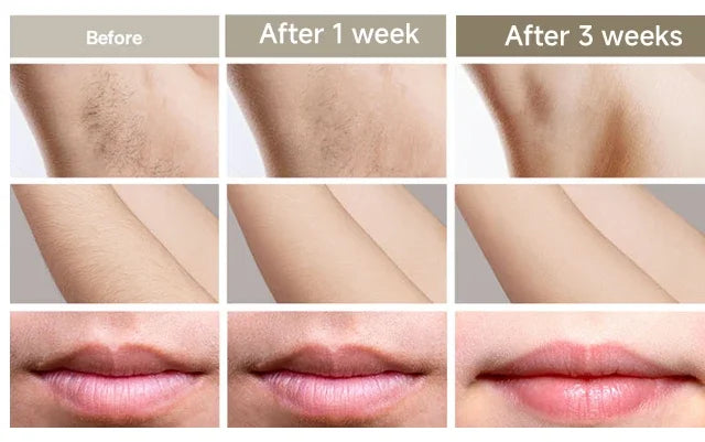 IPL Laser Hair Removal Device