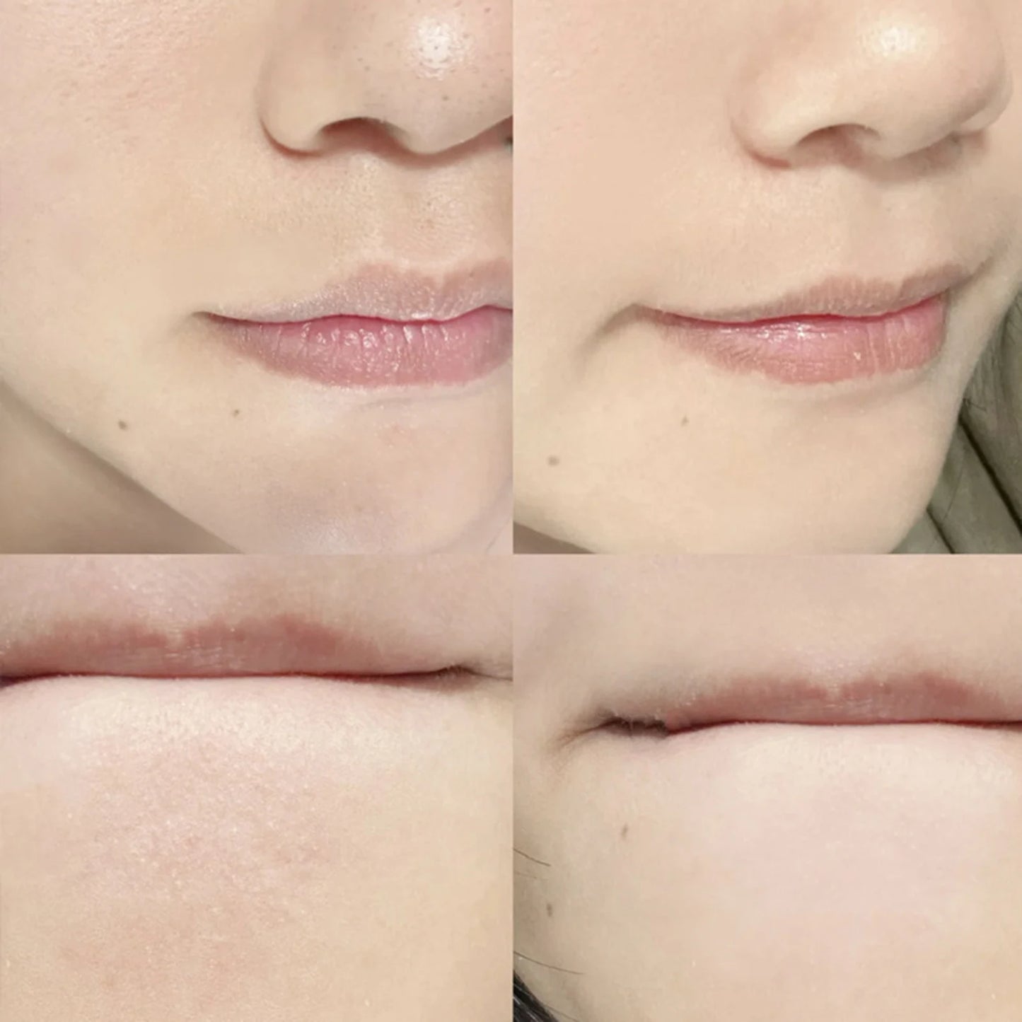Blackhead Remover Tool