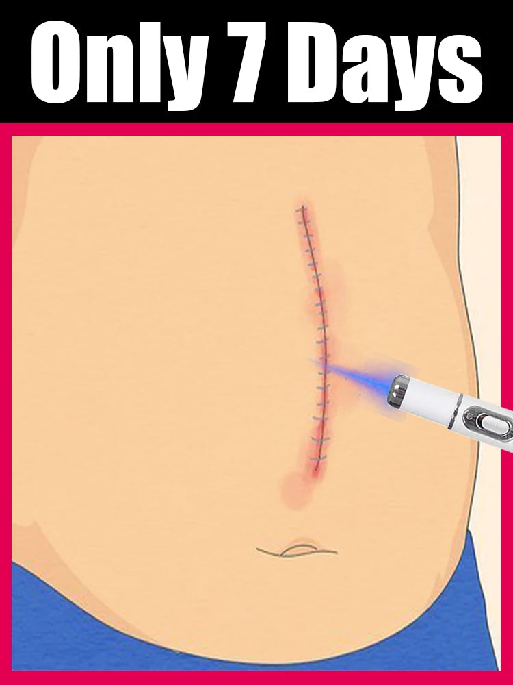 Scar blue light tool Set Can says Goodbye To Flat scars Filiform scars